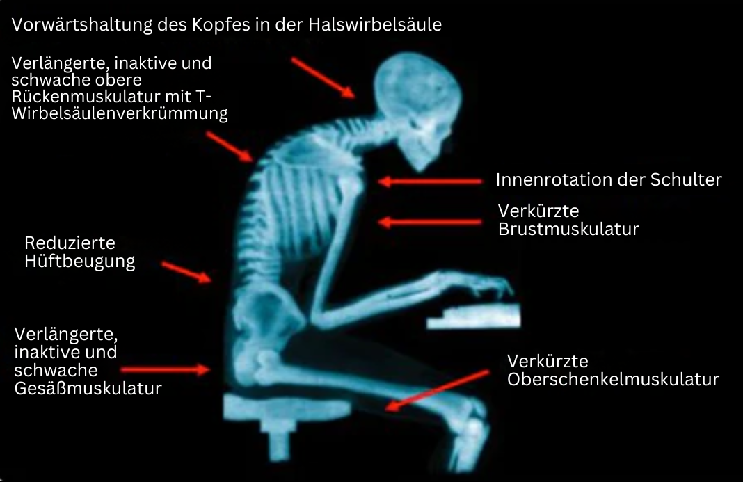 Röntgenbild Mensch mit schlechter Haltung, Wirbelsäulenverkrümmung, Muskelprobleme, Sitzposition.