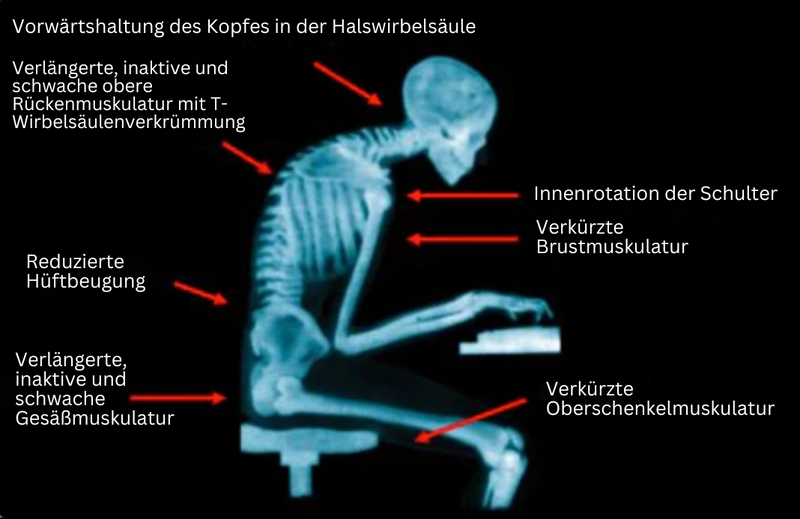 Röntgenbild Mensch mit schlechter Haltung, Wirbelsäulenverkrümmung, Muskelprobleme, Sitzposition.